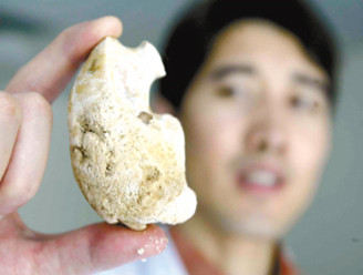 6类食物让你成"石头人!吃什么防肾结石?